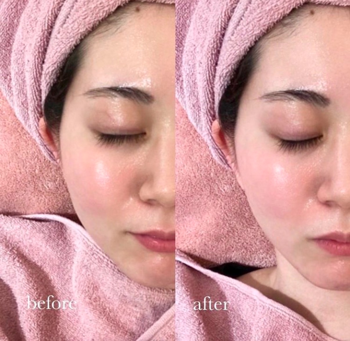 針を刺さない水光注射【ニードレスインジェクター】 – 六本木の隠れ家 